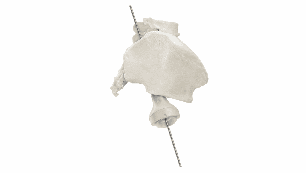 Medical device for pelvic angiosarcoma surgical procedures.