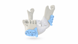 Mandible reconstruction using fibula free flap for jaw restoration.