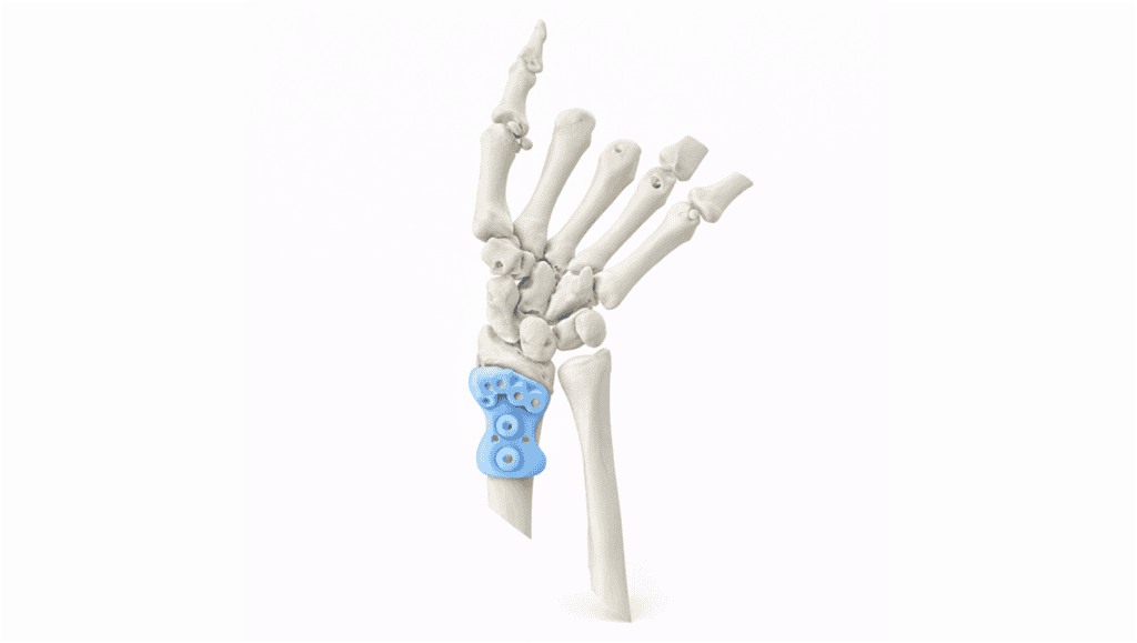 3D model of Madelung’s deformity affecting the wrist bones.