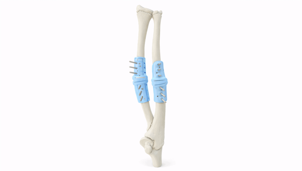 Pediatric ulna and radius bones with surgical fixation for malunion correction.