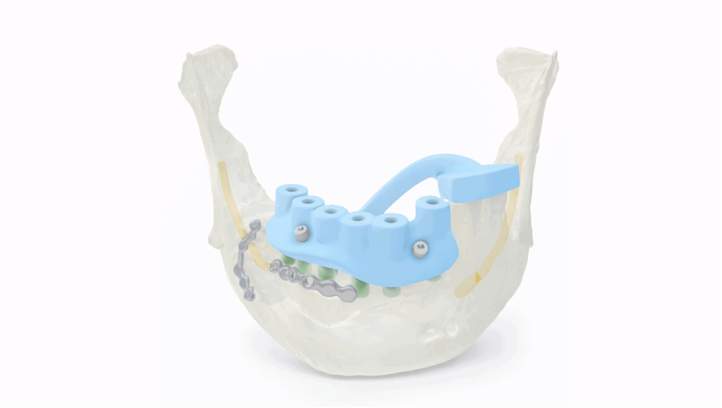 Dental implant positioning guide for fibula free flap reconstruction.