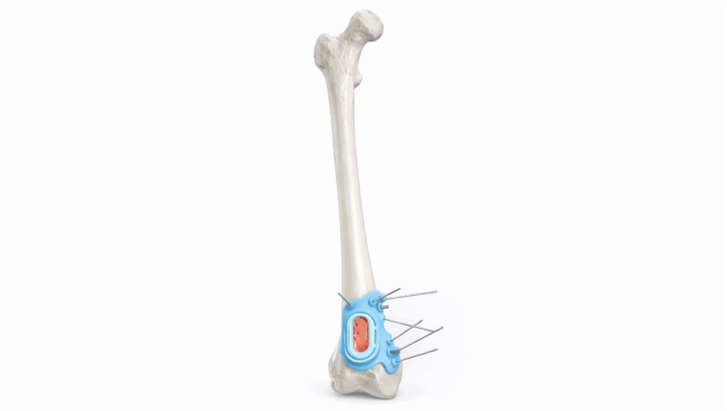 Enchondroma removal with allograft reconstruction of the long bone.