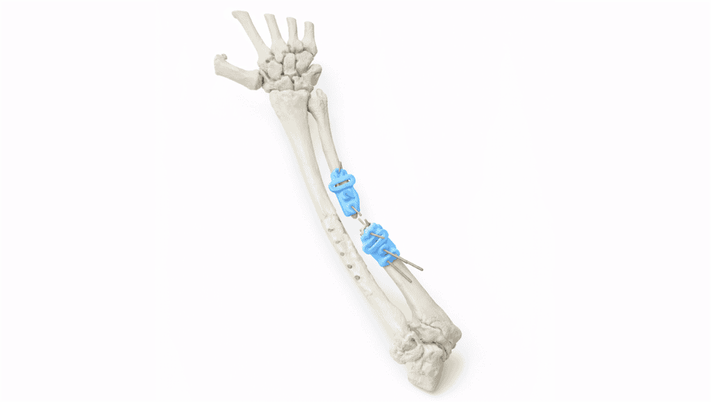 Ulna reconstruction using autograft in complex surgery.