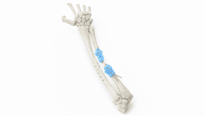 Ulna reconstruction using autograft in complex surgery.