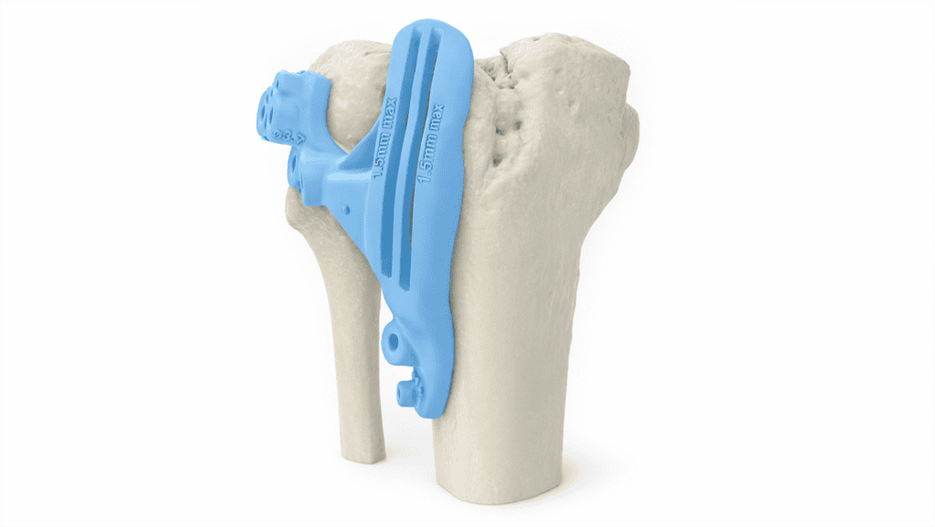 Tibial plateau malunion fixation device for complex knee reconstruction.