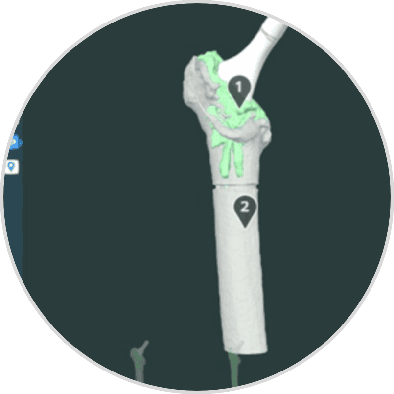 Detailed view of knee joint reconstruction with implants and surgical tools.